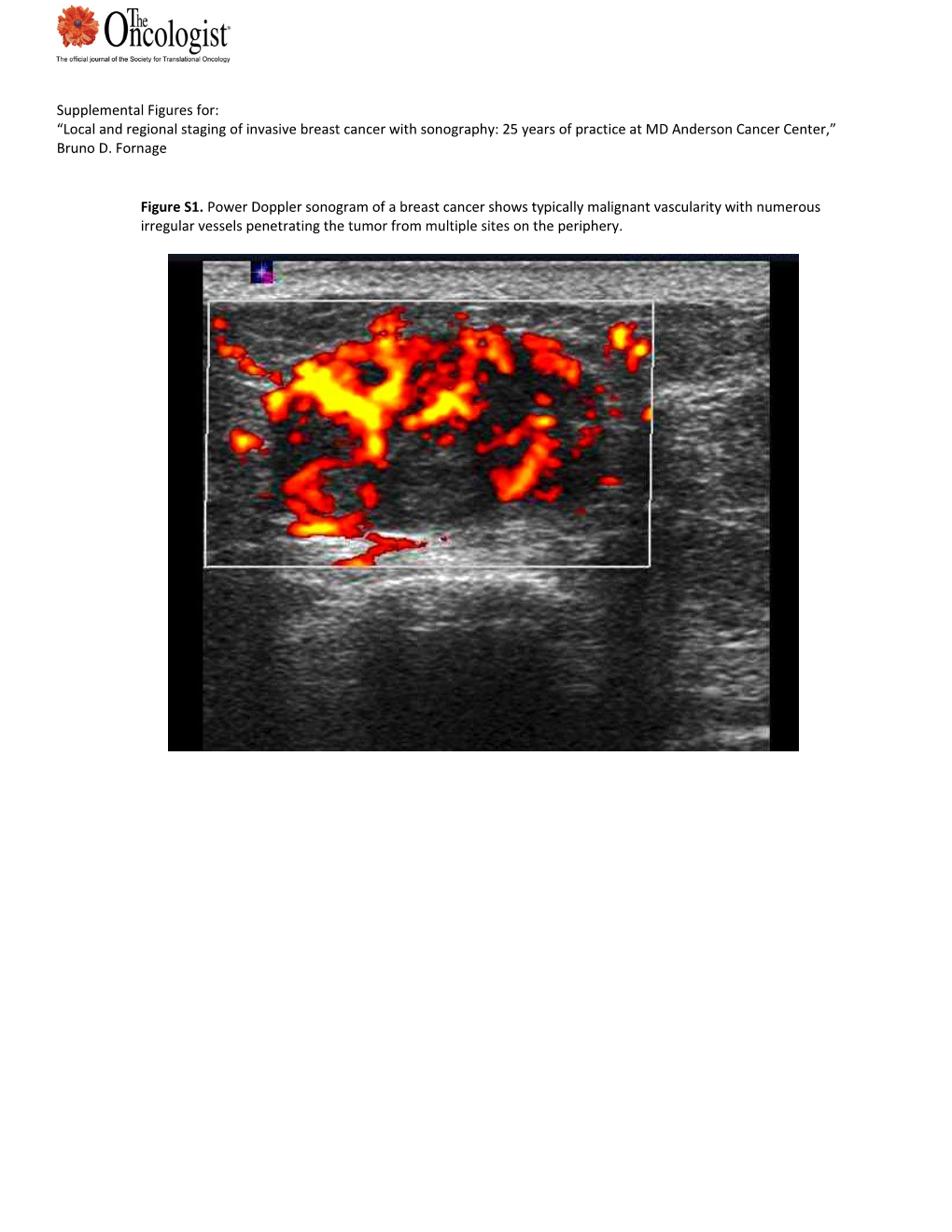 Figure S3.Patient with a Known Cancer in the 11 O Clock Position, 7 Cm from the Nipple