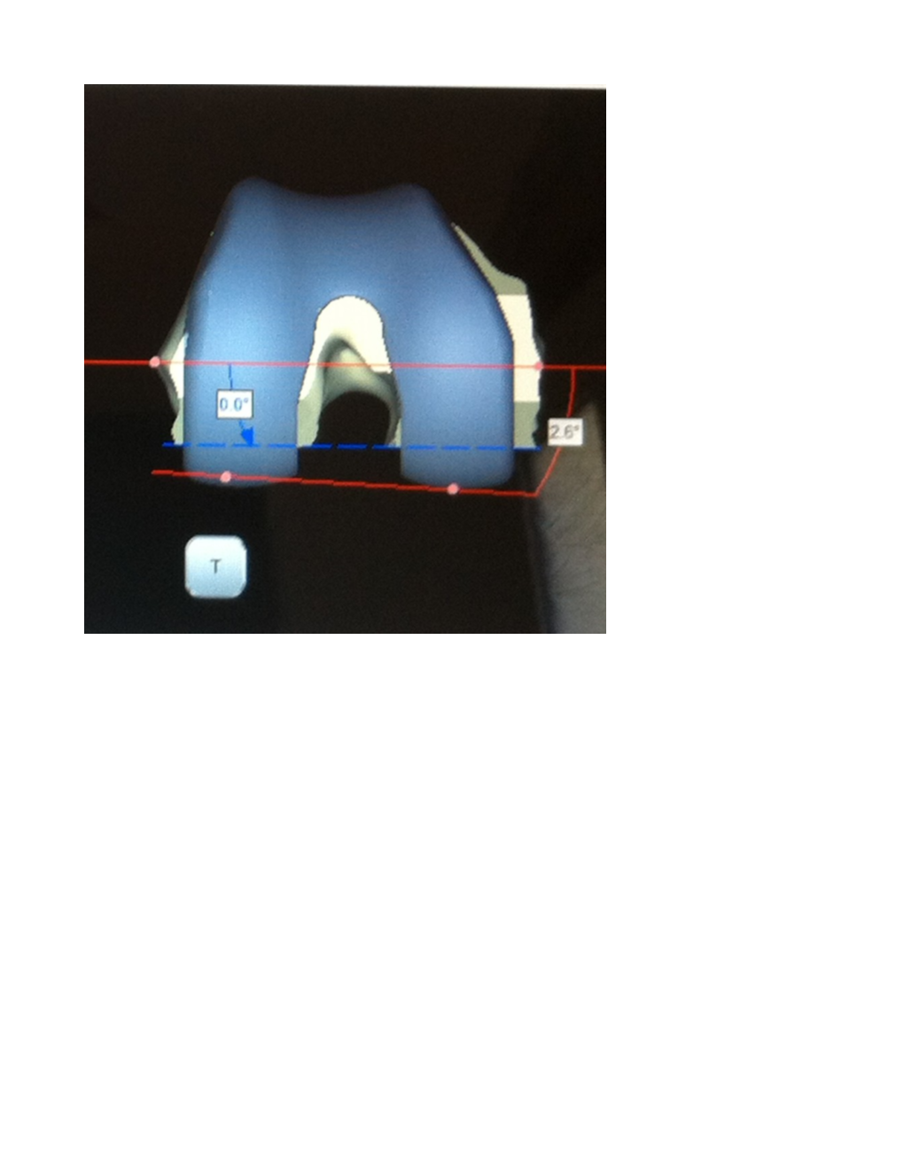 Minimal Invasive Patient Specific Instruments Total Knee Replacement