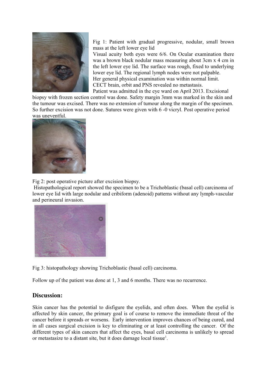 Late Presentation of Basal Cell Carcinoma - a Case Report
