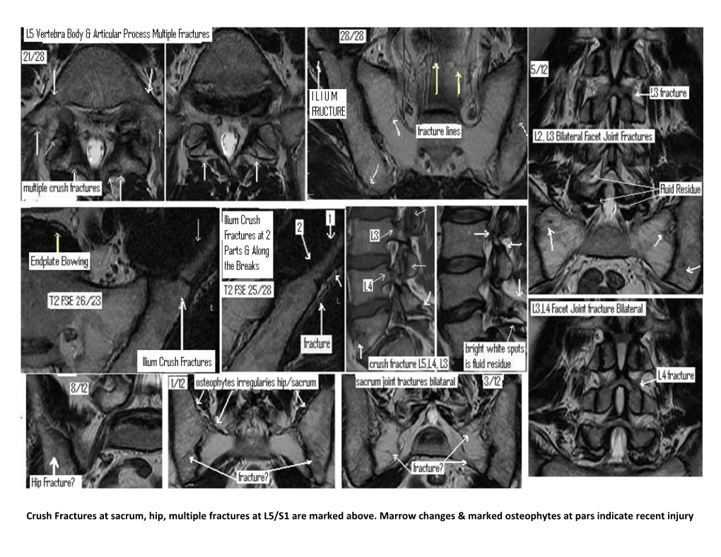 Crush Fractures at Sacrum, Hip,Multiple Fractures at L5/S1 Are Marked Above. Marrow Changes