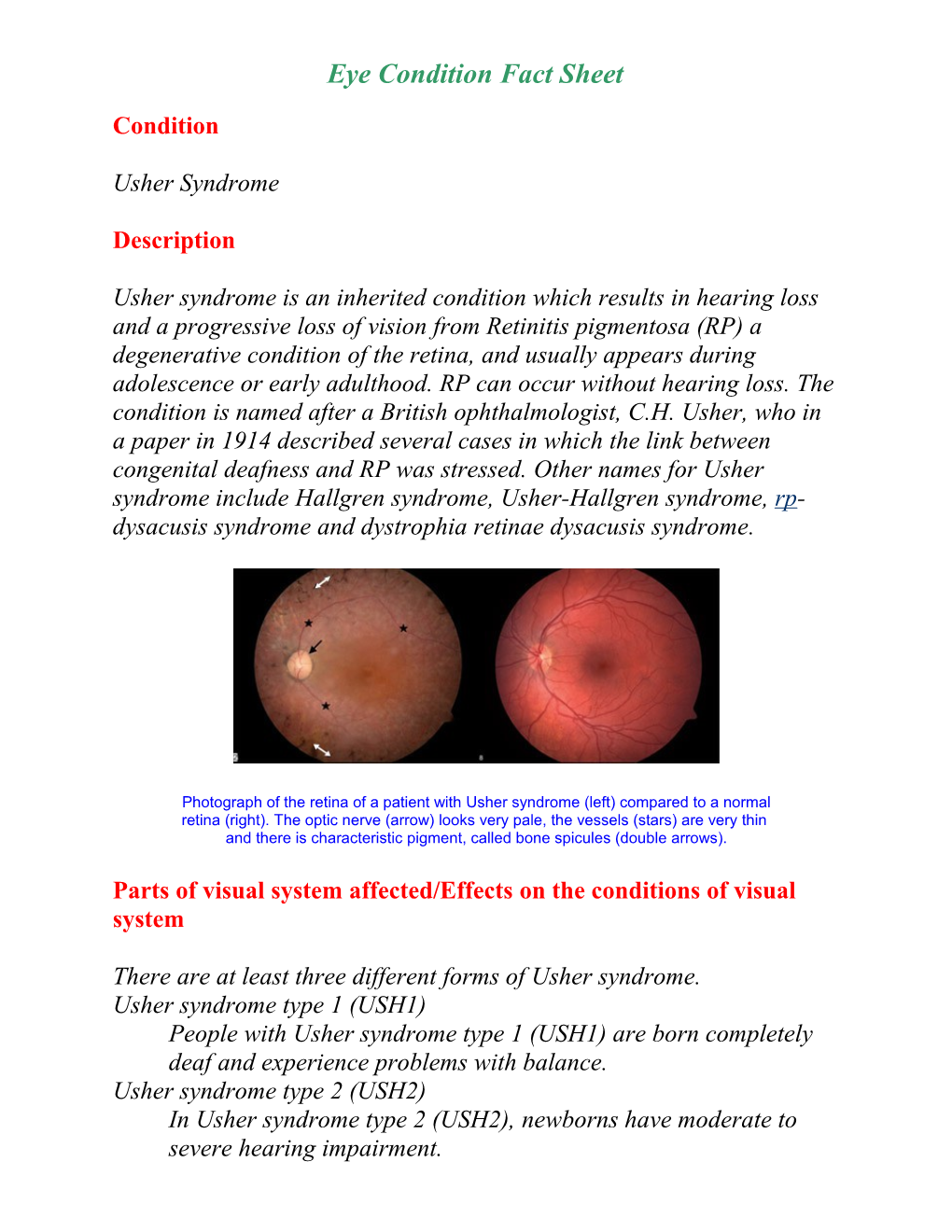 Eye Condition Fact Sheet #1