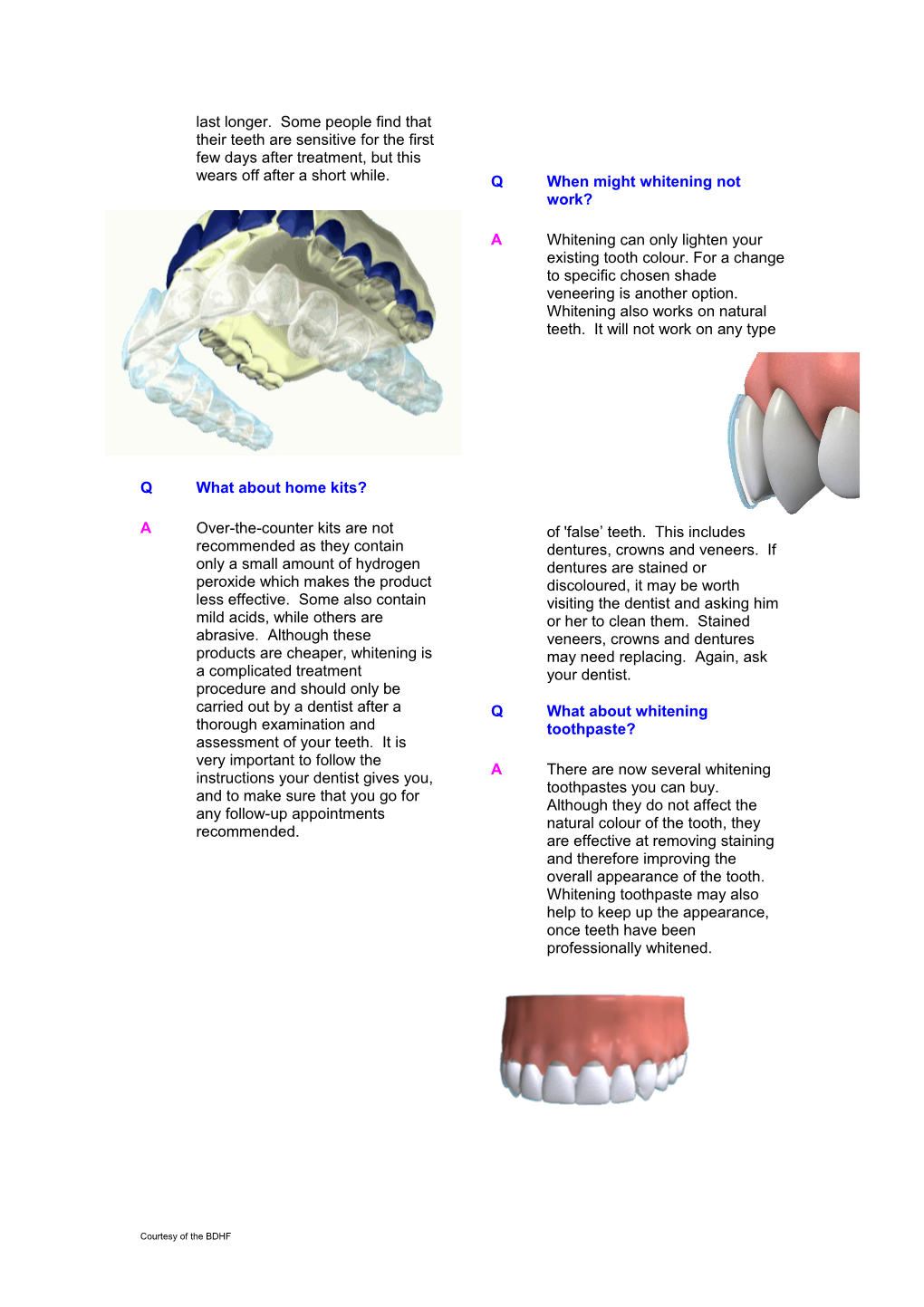 Qwhat Does Tooth Whitening Do?