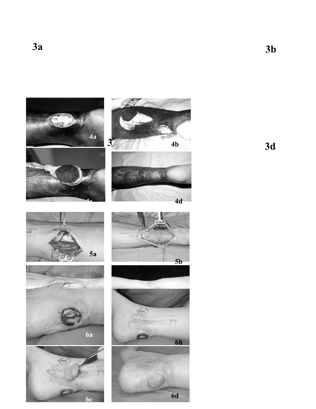 Perforator Based Adipofascial and Fasciocutaneous Flaps for the Treatment of Difficult