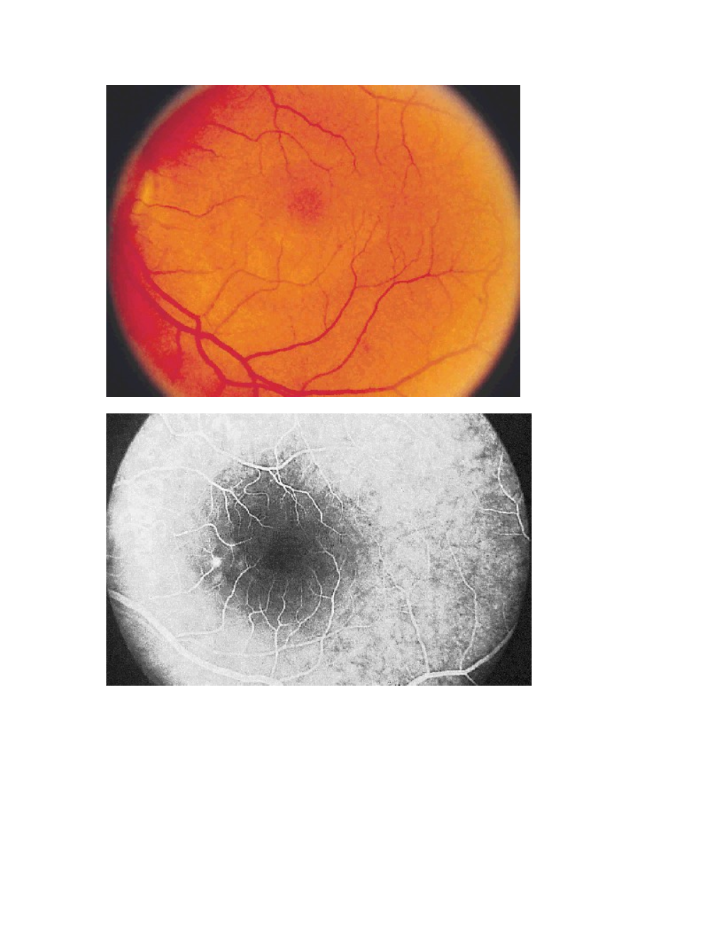 Q: 45 Yo WM Pilot Presents to Your Office Complaining of Central Blurry Vision OD