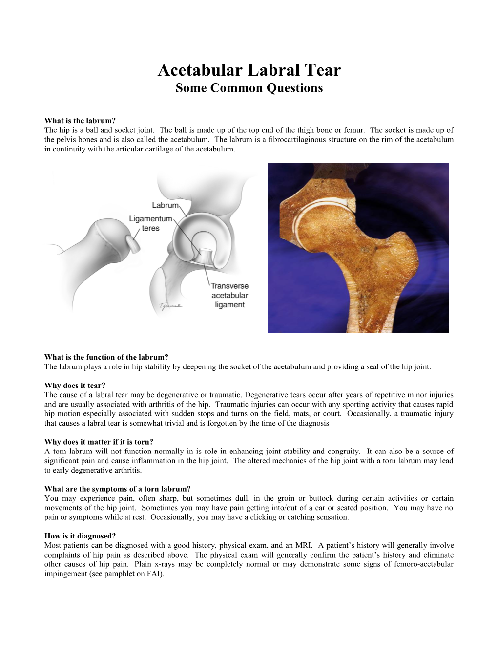 Acetabular Labral Tear