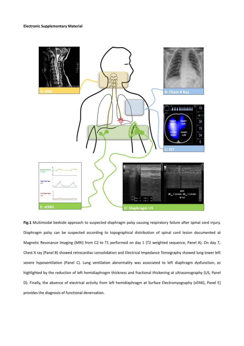 Methods of Surface Electromyography of Respiratory Muscles (Semg) Recording