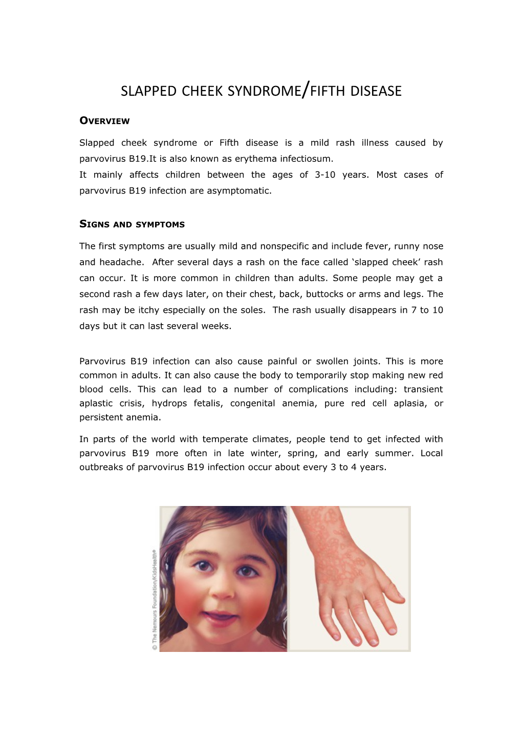 Slapped Cheek Syndrome/Fifth Disease