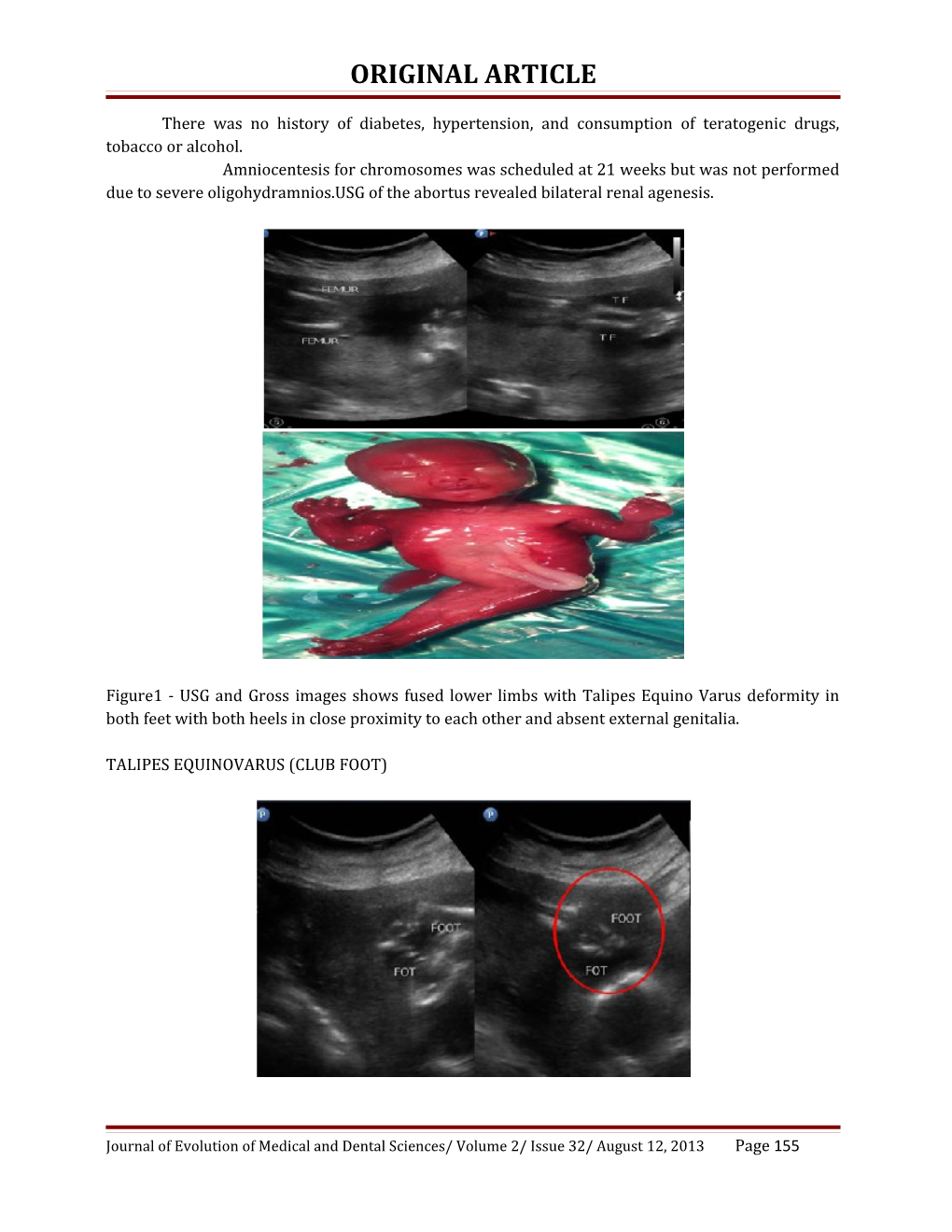 Sirenomelia: a Rare Congenital Anamoly