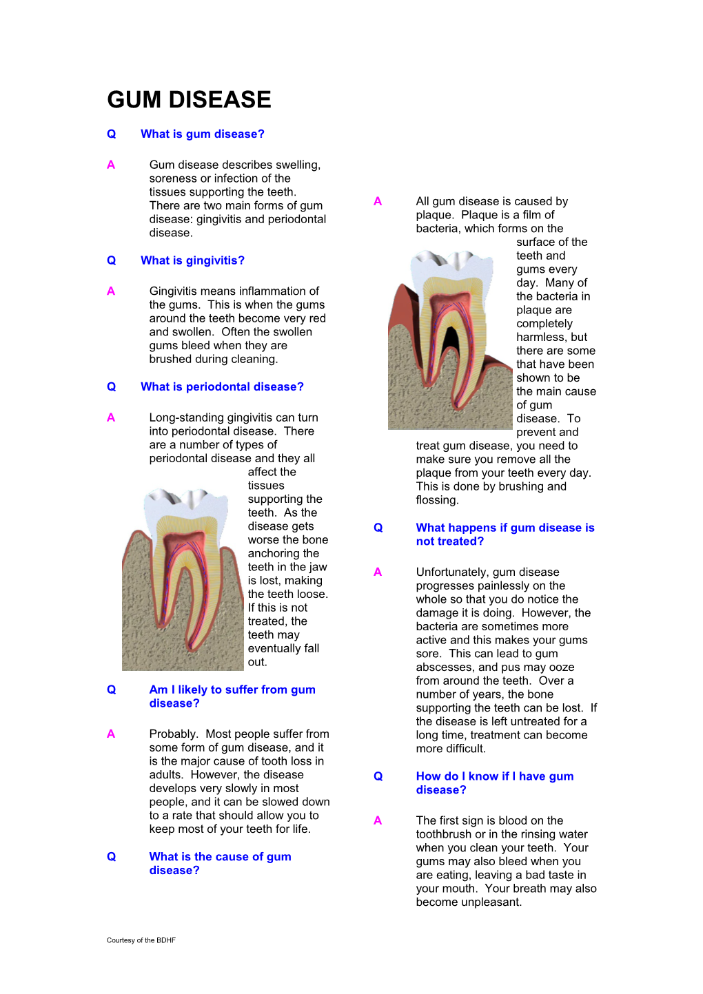 Qwhat Is Gum Disease?