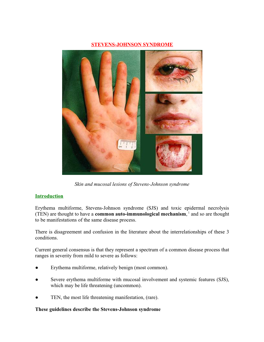 Stevens Johnson Syndrome