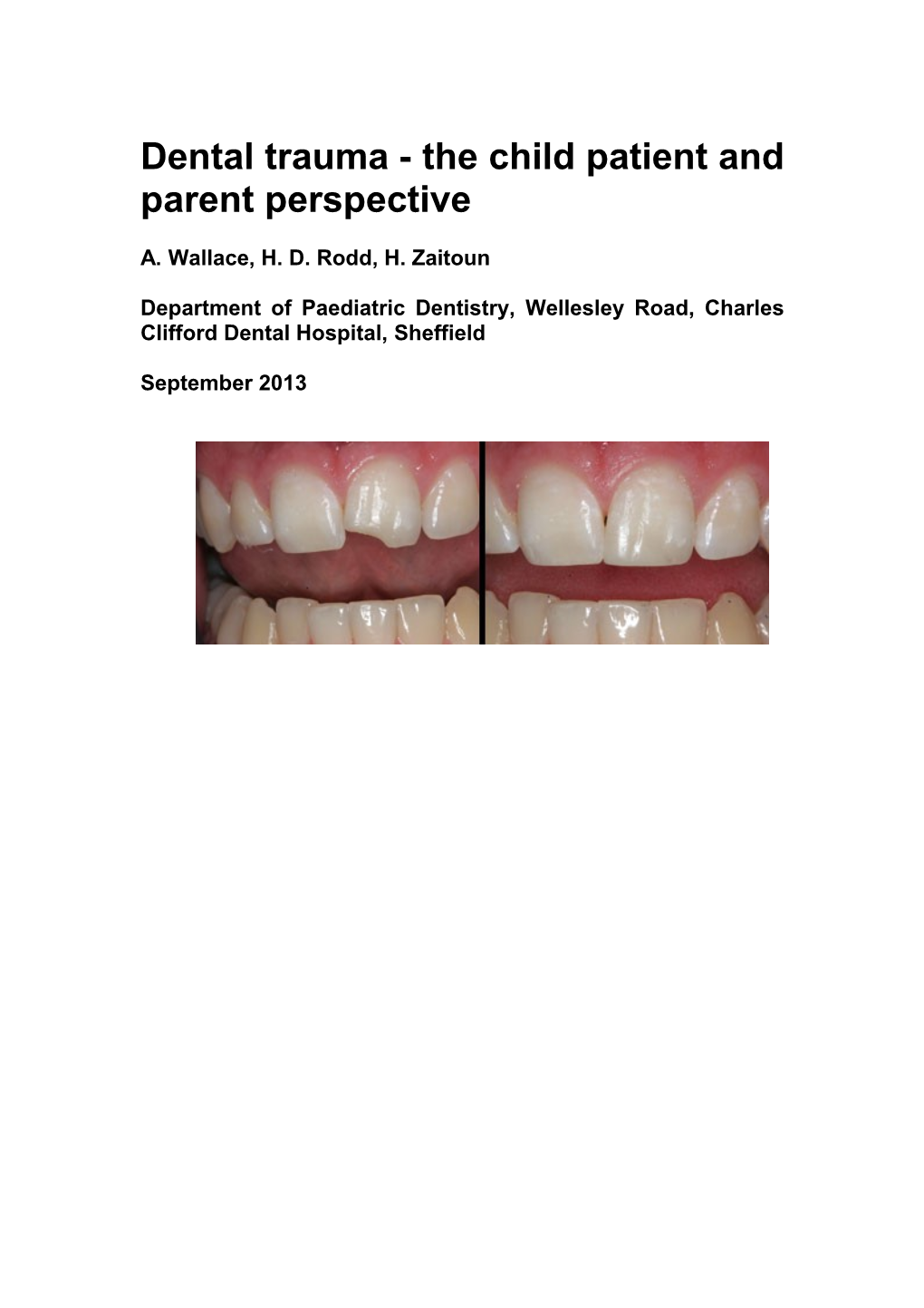 Children Commonly Traumatise Their Permanent Front (Incisor) Teeth, with Reported Injury