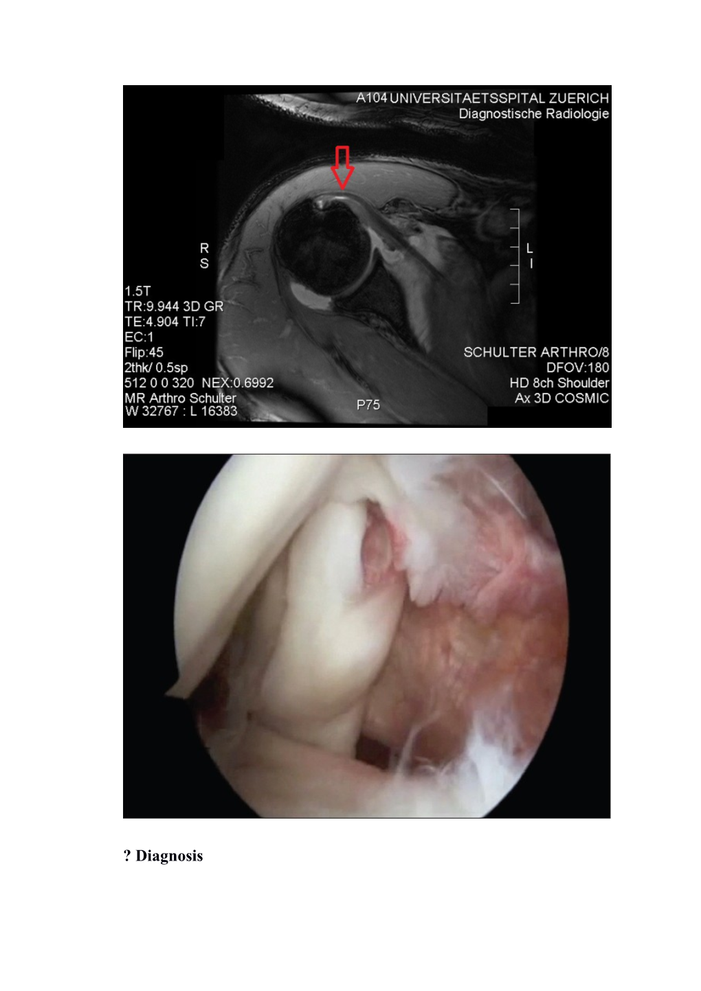 Diagnosis PARTIAL TEAR of the SUBSCAPULARIS