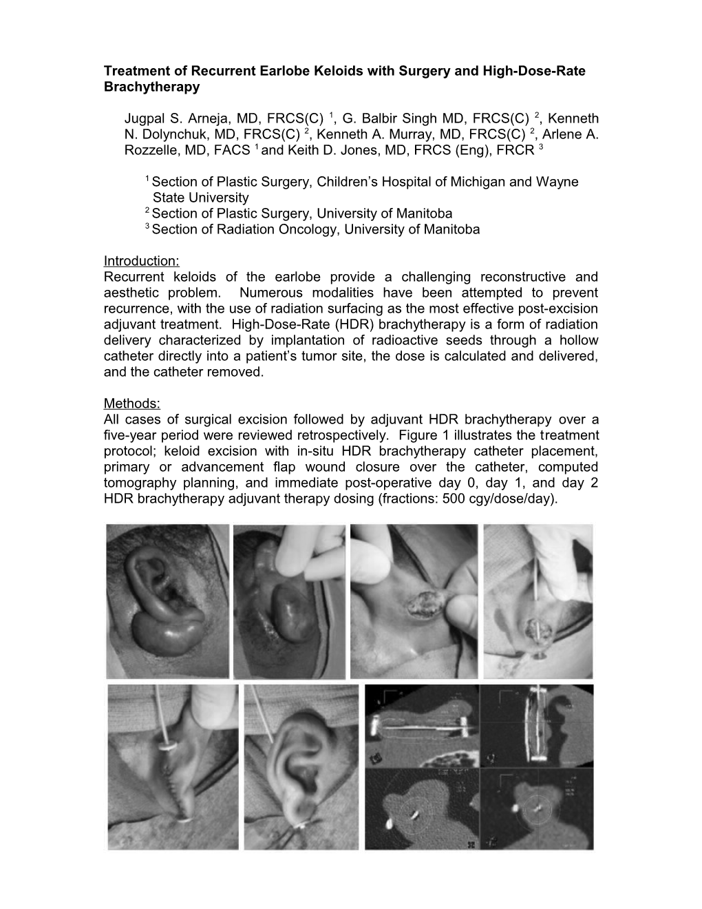 Treatment of Recurrent Earlobe Keloids with Surgery and High-Dose-Rate Brachytherapy