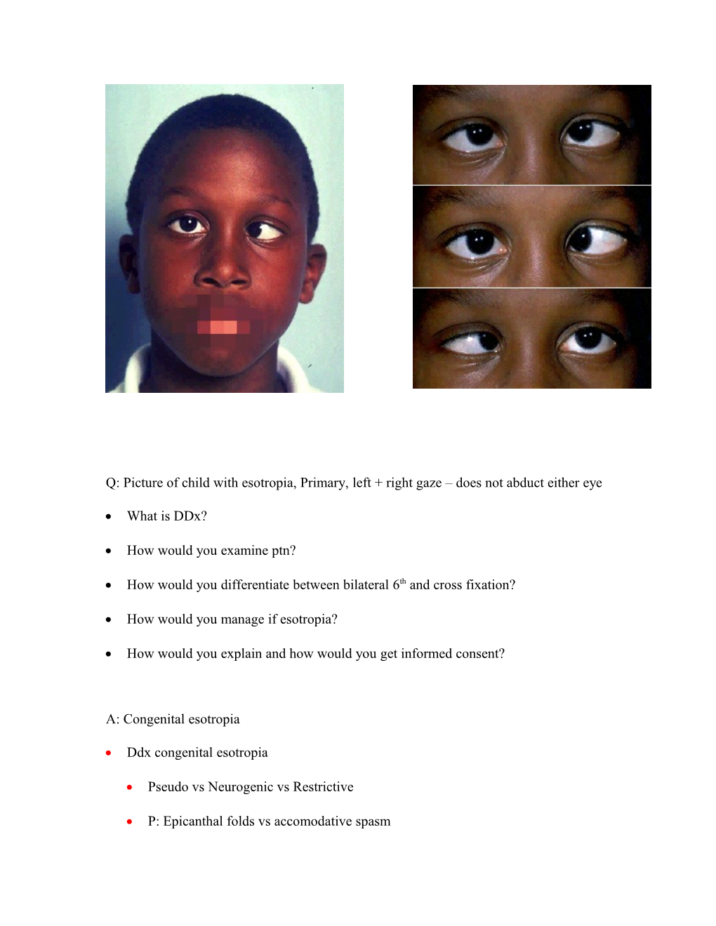Q: Picture of Child with Esotropia, Primary, Left + Right Gaze Does Not Abduct Either Eye