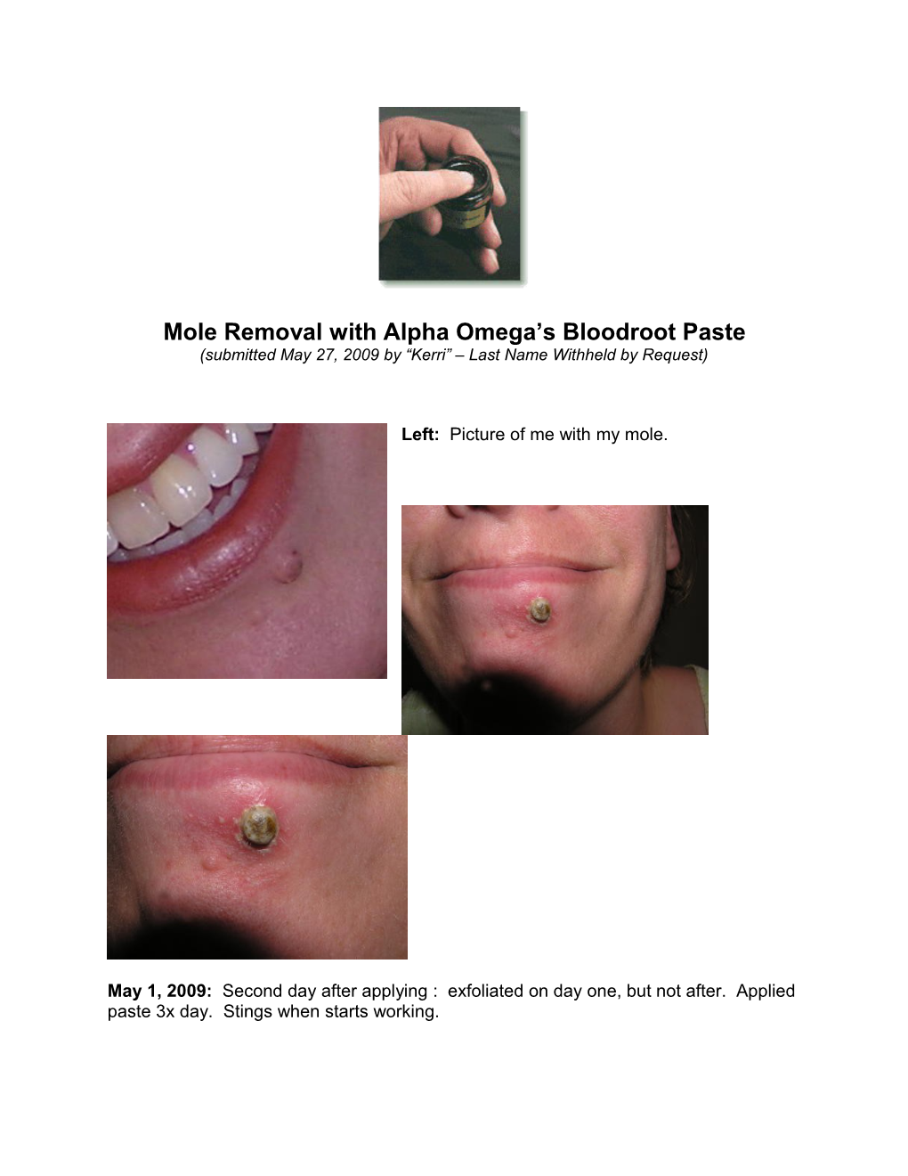 Mole Removal with Alpha Omega S Boodroot Paste