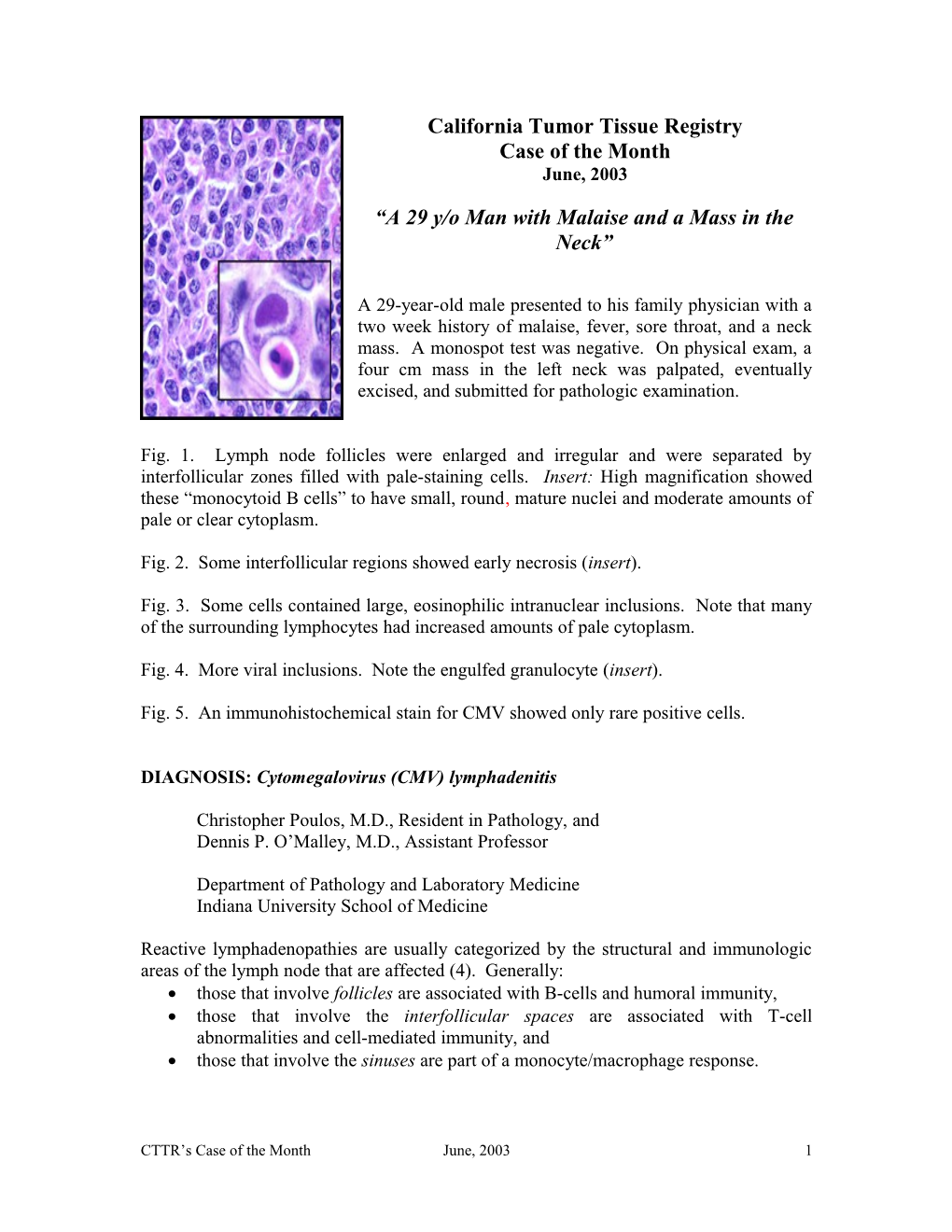 A Case Discussion of Infectious Lymphadenitis Mimicking Lymphoma