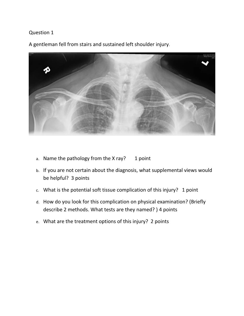 A Gentleman Fell from Stairs and Sustained Left Shoulder Injury