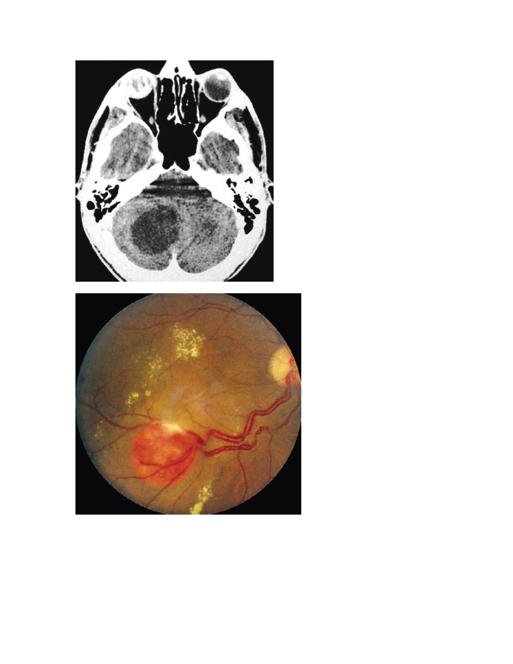 Q: Picture of Cerebellar Cyst Vs Picture of Capillary Hemangioma