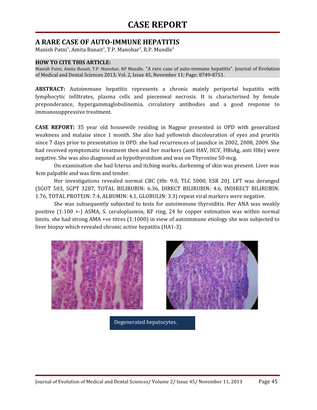 A Rare Case of Auto-Immune Hepatitis