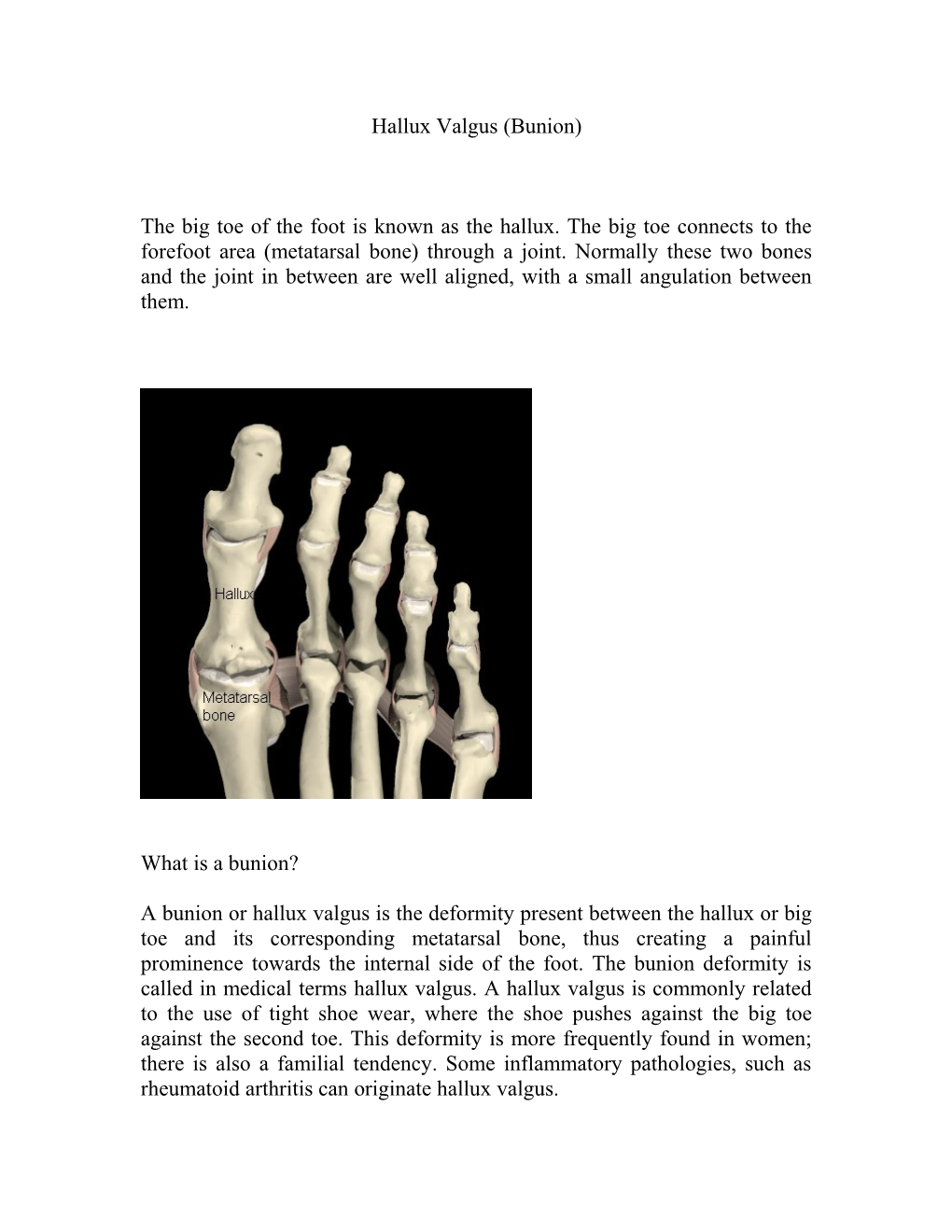 Hallux Valgus (Bunion)